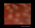streptococcus pyogenes